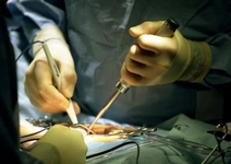 Apandisit Çeşitleri Türleri ve Özellikleri