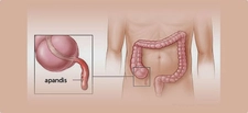 Apandisit Patlaması Belirtileri ve Tedavisi