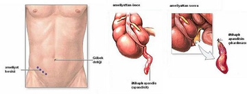 Apandisit Komplikasyonları Belirtileri ve Tedavisi