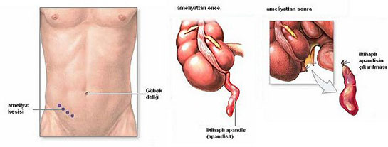 Apandisit Komplikasyonlar