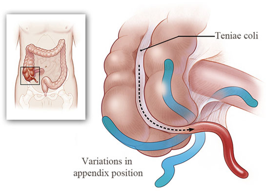 Apandisit Tans