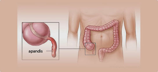 Apandisitte Dikkat Edilmesi Gerekenler